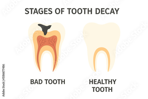 Stages of Tooth Decay and Dental Caries Progression. Comparison of Healthy Tooth and Carious Tooth. Oral Health, Dental Hygiene, Medical Anatomy, Caries Prevention Concept Illustration.