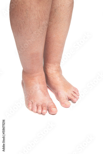 Swollen leg caused by a broken toe. Unrecognizable man with swollen feet, tired and painful legs.Edema lower limbs