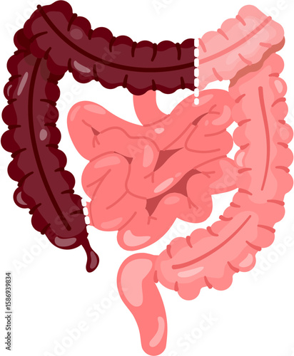Extended Right Hemicolectomy 