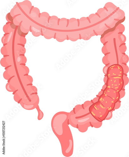 Pseudomembranous colitis