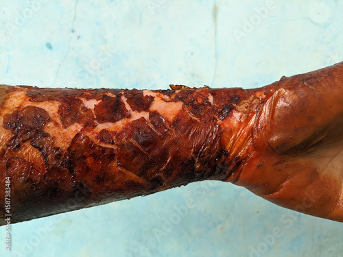 A visual representation of a burned human limb, focusing on the texture and appearance of severely damaged skin. Useful for medical education and illustrating burn severity.