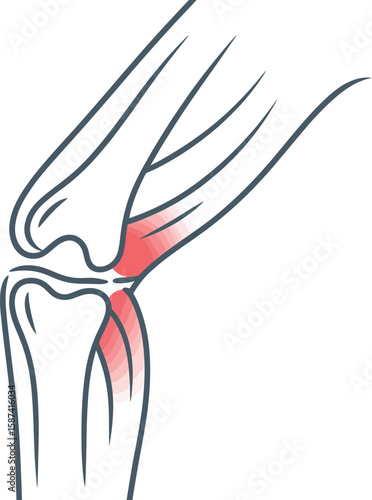 Illustration of a human arm showing the elbow joint with red highlighting of pain area