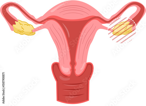 Unilateral Oophorectomy 