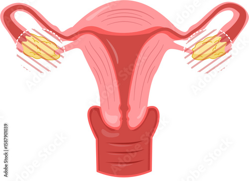 Bilateral Oophorectomy 