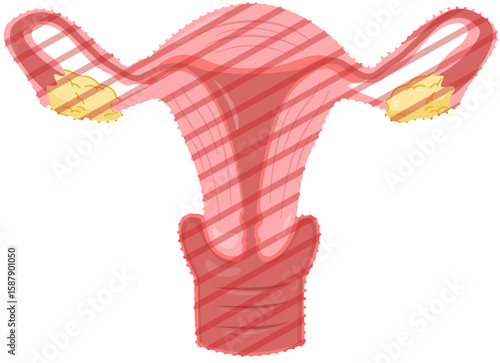 Radical Hysterectomy 