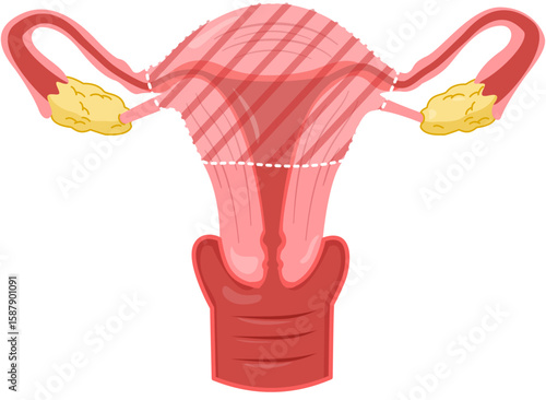 Partial Hysterectomy 