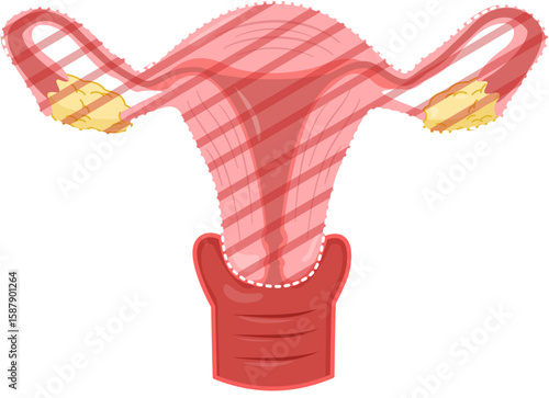 Radical Hysterectomy 