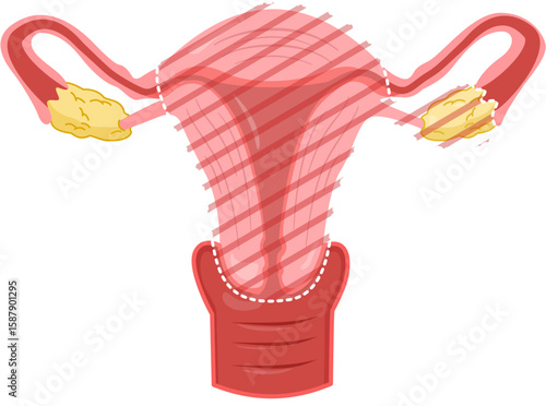 Oophorectomy with Hysterectomy 