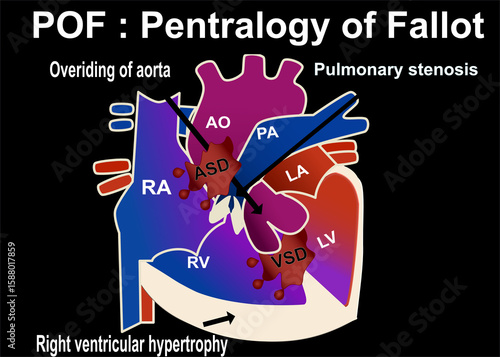 the structure of pentalogy of fallot that show the 5part defect of heart which is overriding of aorta , pulmonary stenosis  ,VSD, right ventricular hypertrophy,ASD for medical concept