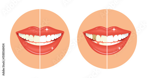Comparison bleaching teeth treatment. Whiten teeth before and after. Dental care concept. Imperfect smile. Clean and healthy. Illustration of an open perfect female white smile. 