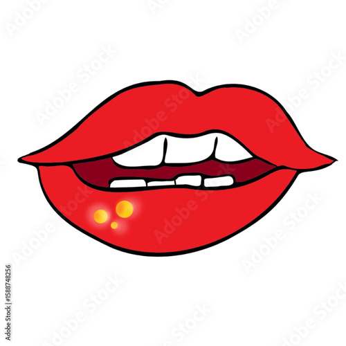 mouth ulcer canker sores vitamin deficiency symptom in lips medical illustration.eps