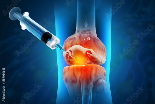 Injection into the knee joint. Drug treatment method for alleviating knee injuries in human. 3d illustration