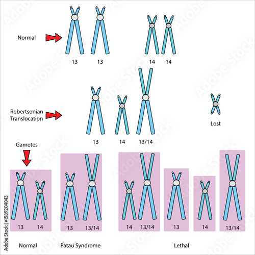 Robertsonian Translocation Chromosome Abnormalities and Genetic Outcomes