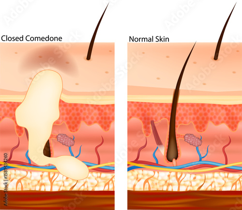 Для ИнтернетаMedical Illustration of the Closed Comedone and Normal Skin. The image reveals the skin layers, hair follicles, sebaceous glands, and differences in pore blockage. 