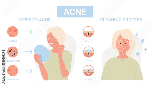 Type of acne on facial skin, steps of infection treatment for face pores infographic flat vector illustration. Cartoon girl with dermis problem of inflammation, scars. Medicine, skincare concept