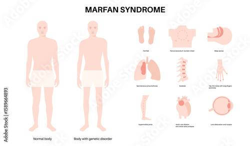Marfan syndrome poster