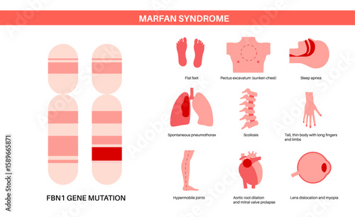 Marfan syndrome poster