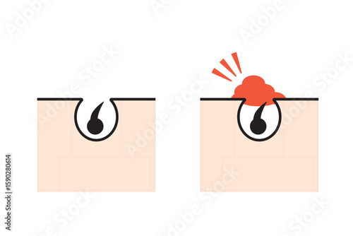 正常な毛穴と炎症による毛穴トラブルの比較イラスト