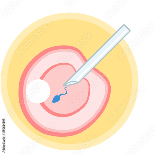 IVF ICSI vector illustration. Perfect for presenting anything about reproduction, insemination or ivf. Vertical position with yellow background.