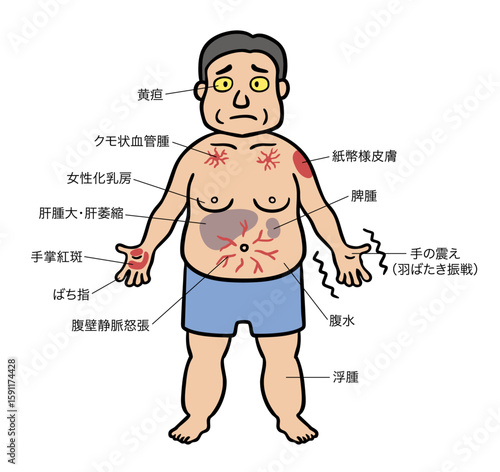 肝硬変の症状が出ている中年男性のイラスト
