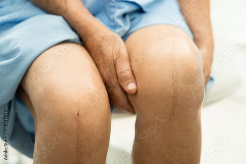 Asian elderly woman patient show her scars surgical total knee joint replacement Suture wound surgery arthroplasty on bed in hospital.