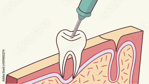 Understanding root canal treatment procedure diagram for dental health and oral hygiene information guide