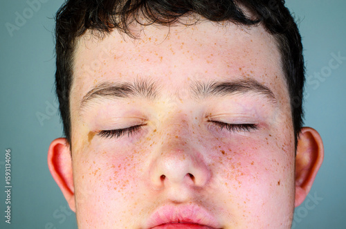 Close up of teenage boy face with closed eyes and freckles