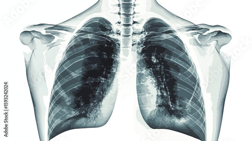 Lung X-ray with white background image