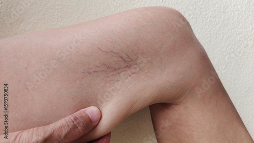 close up the fingers holding the flabbiness and wrinkle, problem circulation of blood, varicose veins and spider, overweight and scar on the leg of the woman, health care and beauty concept.