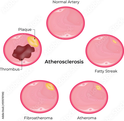 Atherosclerosis Stages of Artery Plaque Buildup Vector Illustration.
