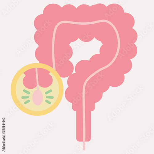 Appendicitis vector illustration highlighting key symptoms like pain, nausea, fever; includes similar diseases such as ovarian cysts and gastroenteritis, intestines