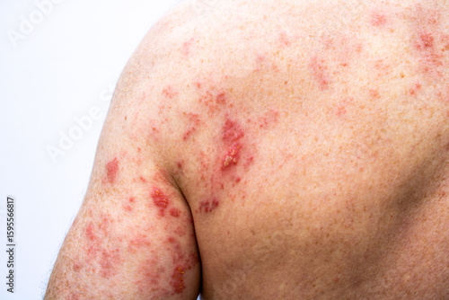Foto The shingles skin rash located on the back and the back of the arm of an adult male