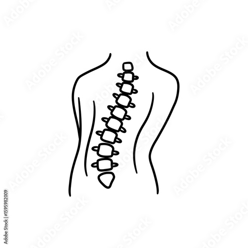 Kyphosis Exaggerated Back Curve, Spinal Deformity, Posture Disorder