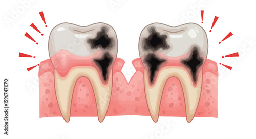 Detailed 3d illustration of tooth decay with cavities and gum inflammation