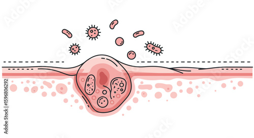 Acne diagram: bacteria and pore inflammation concept in linear style