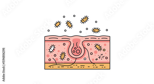 Bacteria on human skin pore with acne infection in detailed flat design