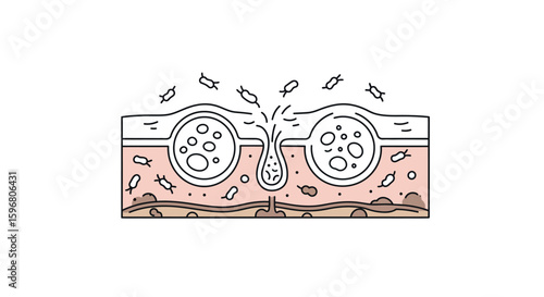 Acne development diagram showing pore blockage and bacterial growth in skin cross section
