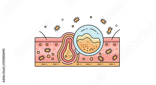 Flat style illustration of acne formation with magnified view of pores and bacteria