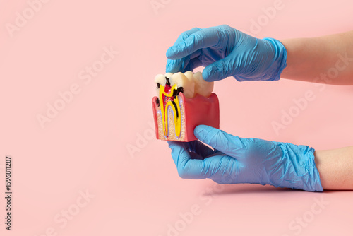 Dental 3D model of the oral cavity in section. On the model there is a tooth damaged by caries. Creative concept on a pastel background
