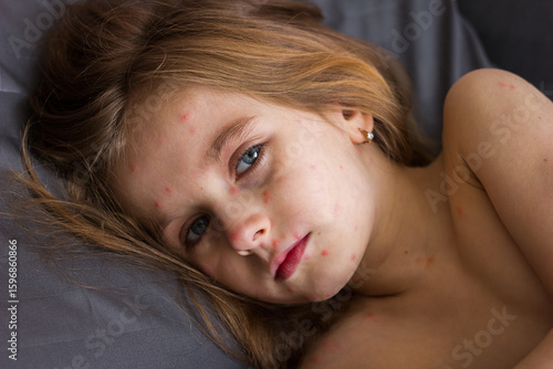 Little sad girl with a rash on her face and body lies in bed with a toy, chickenpox or measles virus in children	