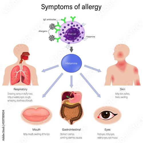 Symptoms of allergy. Symptoms can occur in the respiratory system, skin, digestive system, mouth, and eyes. Mechanism of allergy. Allergens, antibodies and Mast cell. Human immune system. 