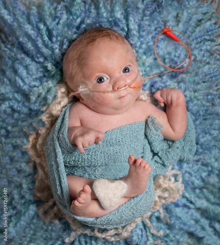 Adorable tiny two month old Trisomy 18 special needs infant boy with oxygen and nasogastric tube for feeding