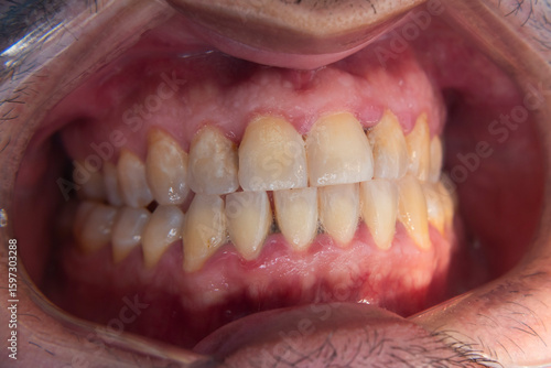Foto Macro dental photos showing plaque accumulation, mild enamel demineralization, and anterior crowding in adult male patient’s teeth, prior to oral prophylaxis