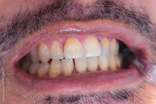 Foto Macro dental photos showing plaque accumulation, mild enamel demineralization, and anterior crowding in adult male patient’s teeth, prior to oral prophylaxis