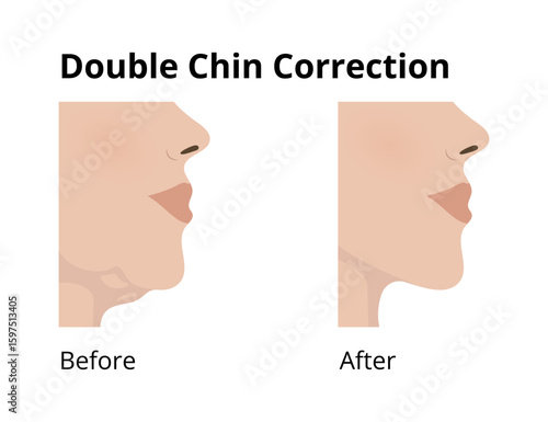 Woman face profile showing double chin correction, before and after