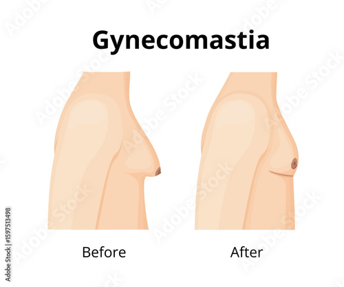 Gynecomastia surgery showing male chest before and after