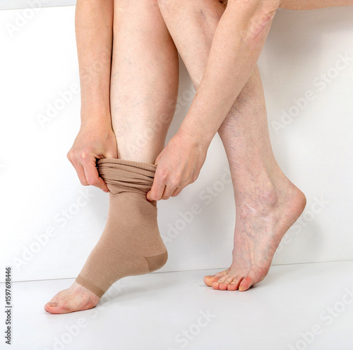 Woman putting on beige compression sock. Medical treatment and health care for leg and vein disease with varicose vein.