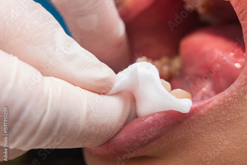 Фототапет Dental professional wipes the patient's gums and lower lip with gauze after oral prophylaxis to remove debris and excess paste