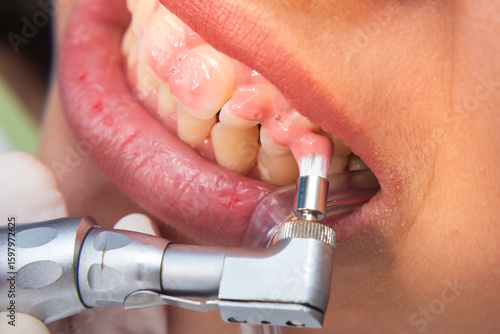 Fotografija Closeup of dental hygienist using prophy angle handpiece with rubber cup to polish teeth near the gumline for plaque removal