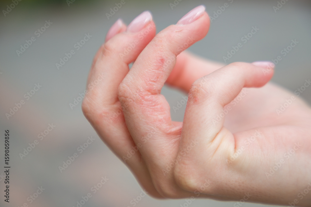 Φωτογραφία Close-up view of the fingers of a girl with dyshidrotic eczema